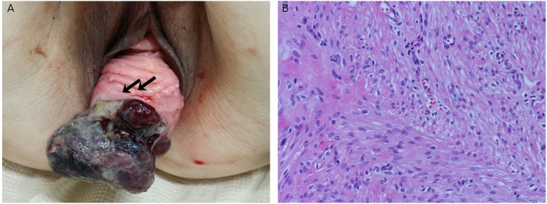 Necrotizing ruptured vaginal leiomyoma mimicking a malignant neoplasm