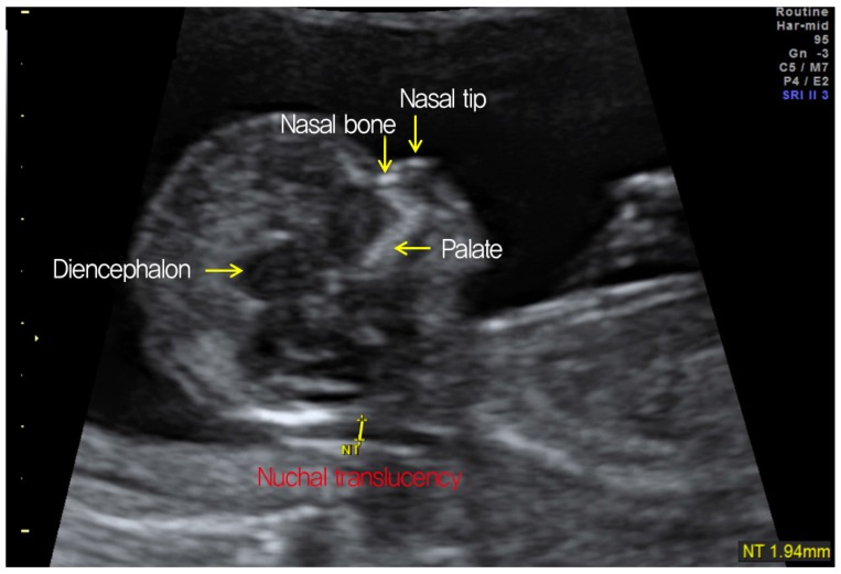 Measurement of nuchal translucency (NT) and other landmarks. 